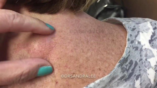 Boynundaki kisti kesti ve... - 3