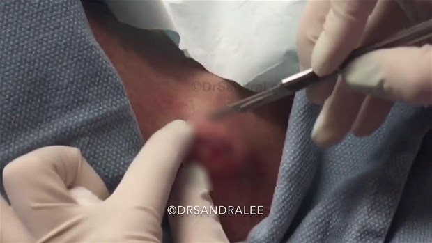 Boynundaki kisti kesti ve... - 4