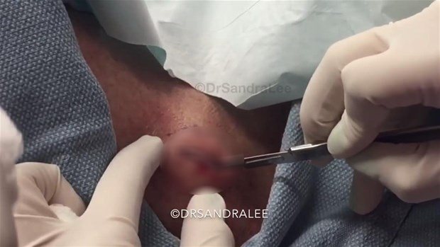 Boynundaki kisti kesti ve... - 5