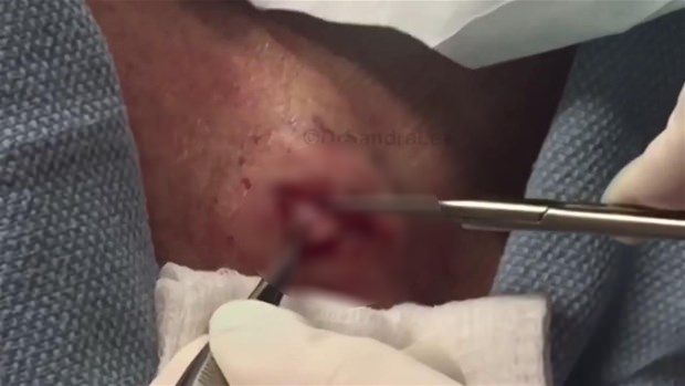 Boynundaki kisti kesti ve... - 6