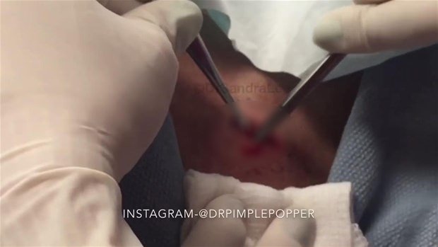 Boynundaki kisti kesti ve... - 7