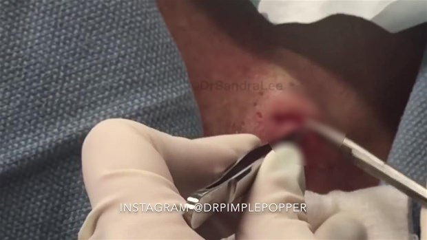 Boynundaki kisti kesti ve... - 8