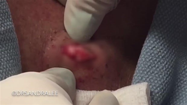 Boynundaki kisti kesti ve... - 9