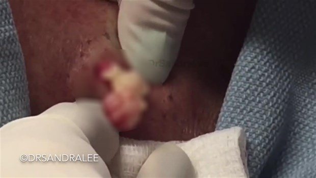 Boynundaki kisti kesti ve... - 10