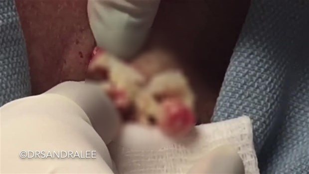 Boynundaki kisti kesti ve... - 11