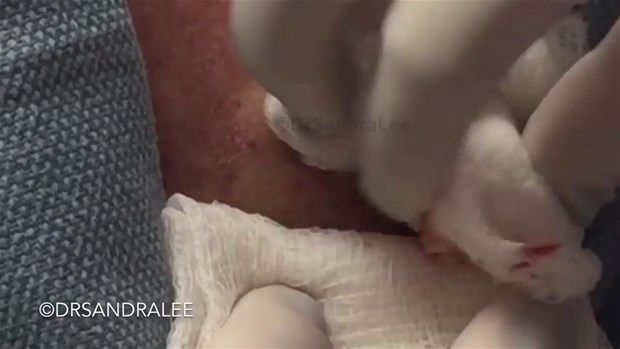 Boynundaki kisti kesti ve... - 12