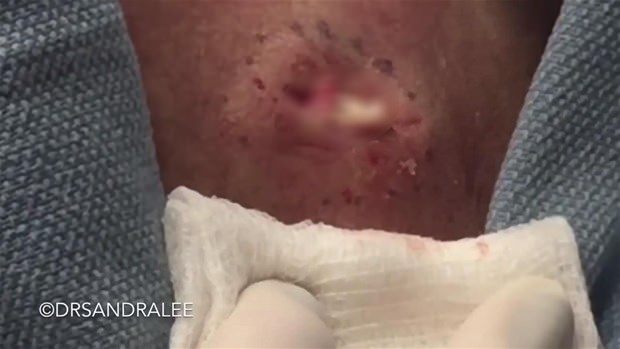 Boynundaki kisti kesti ve... - 13