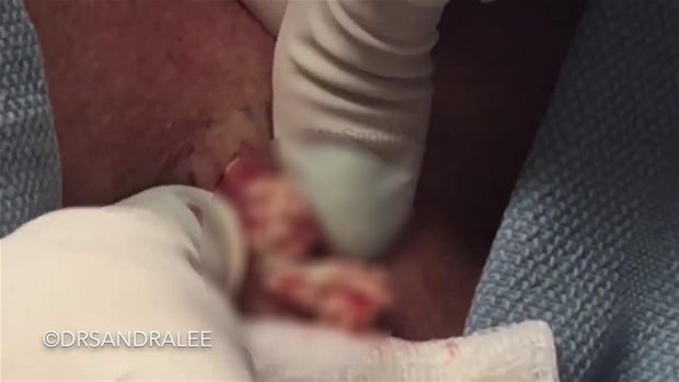 Boynundaki kisti kesti ve... - 14