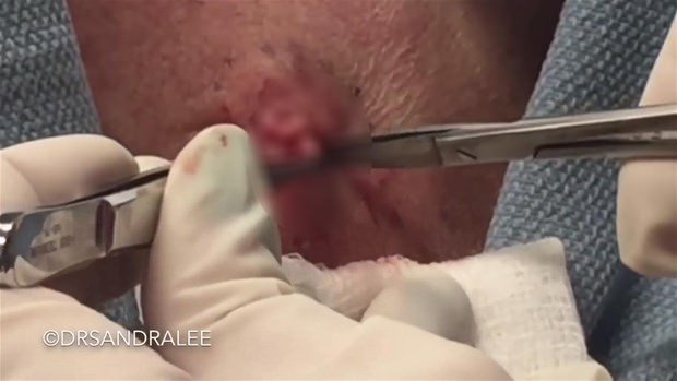 Boynundaki kisti kesti ve... - 15