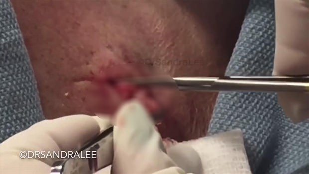 Boynundaki kisti kesti ve... - 16