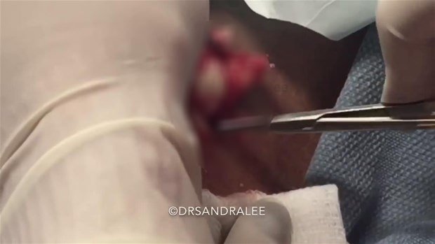 Boynundaki kisti kesti ve... - 17