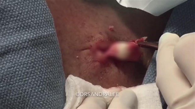 Boynundaki kisti kesti ve... - 18