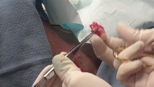 Boynundaki kisti kesti ve... - 19