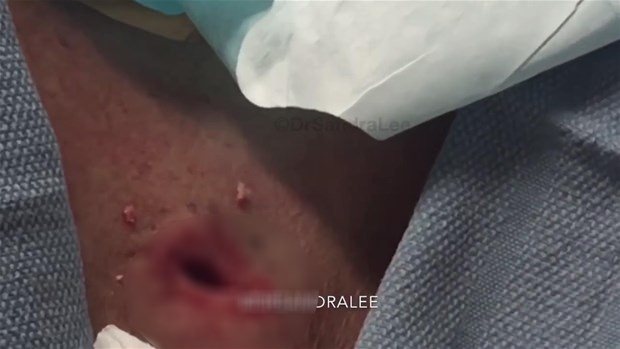 Boynundaki kisti kesti ve... - 20