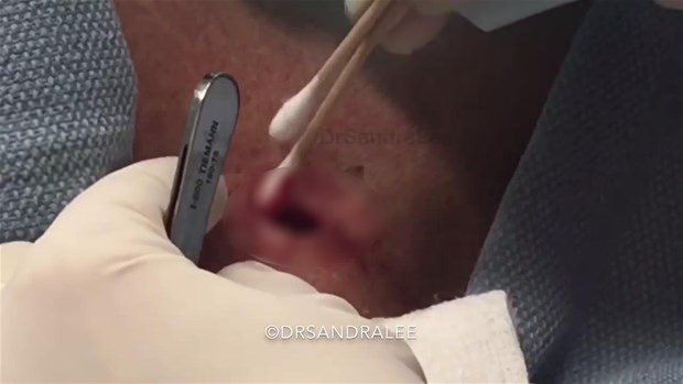 Boynundaki kisti kesti ve... - 21