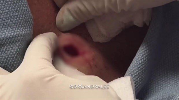 Boynundaki kisti kesti ve... - 22