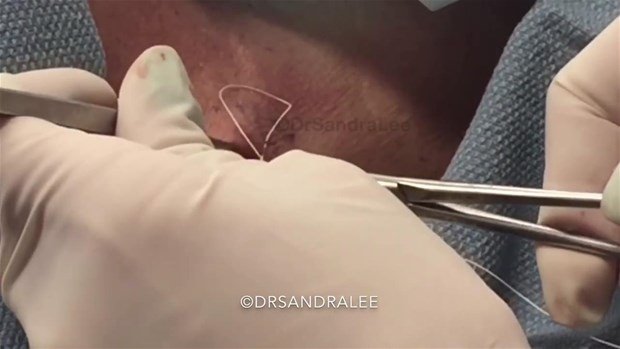 Boynundaki kisti kesti ve... - 23