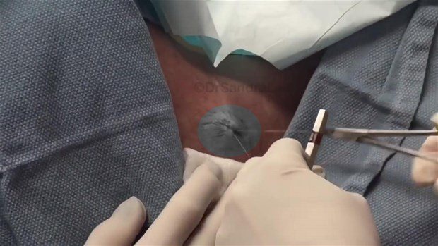 Boynundaki kisti kesti ve... - 24