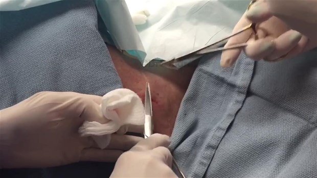 Boynundaki kisti kesti ve... - 25