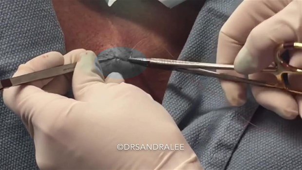 Boynundaki kisti kesti ve... - 26