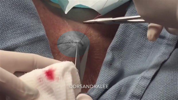 Boynundaki kisti kesti ve... - 27