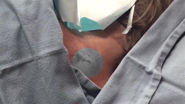 Boynundaki kisti kesti ve... - 28