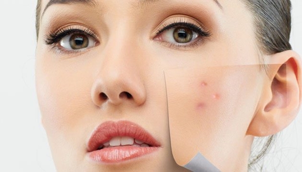 Sivilceye bunlar sebep oluyor! - 1