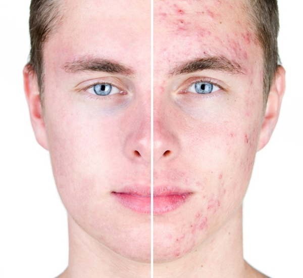 Sivilceye bunlar sebep oluyor! - 2