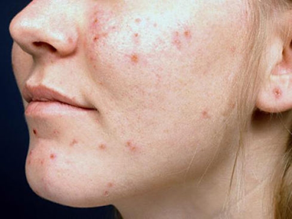 Sivilceye bunlar sebep oluyor! - 5