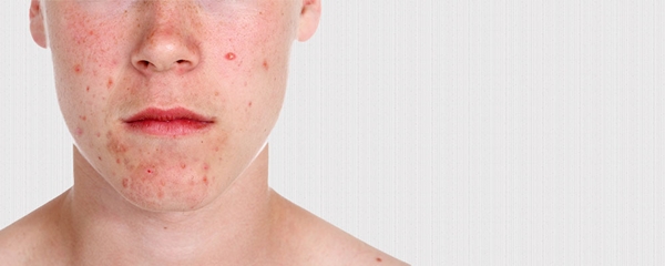 Sivilceye bunlar sebep oluyor! - 6