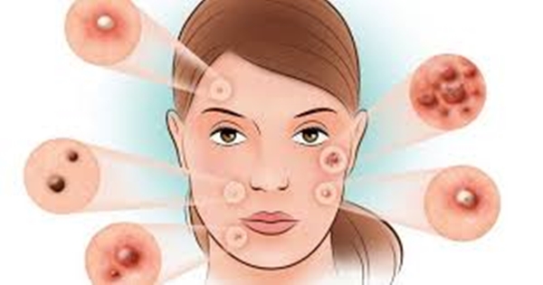 Sivilceye bunlar sebep oluyor! - 8