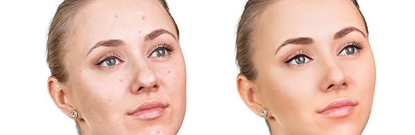 Sivilceye bunlar sebep oluyor! - 9