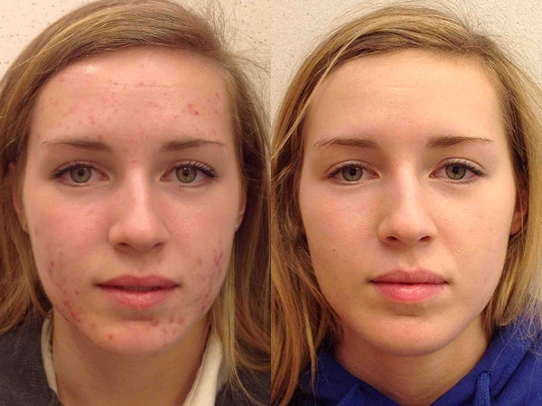 Sivilceye bunlar sebep oluyor! - 13