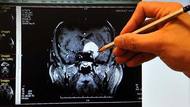 Beyin kanseri görülebilir mi - 3