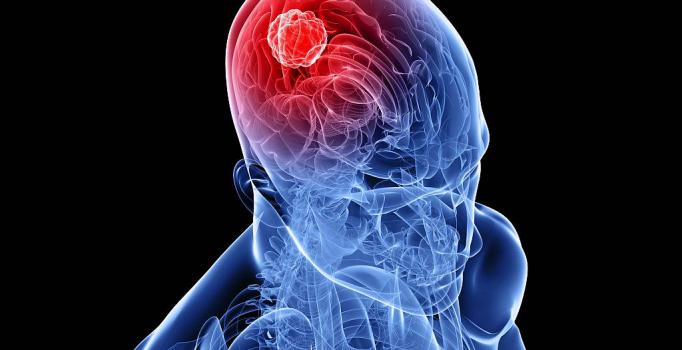Beyin kanseri görülebilir mi - 4