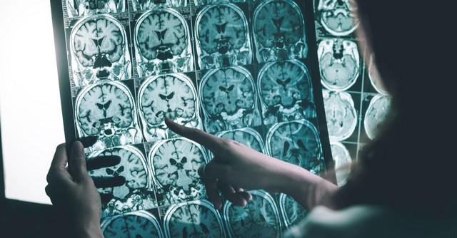 Beyin kanseri görülebilir mi - 5