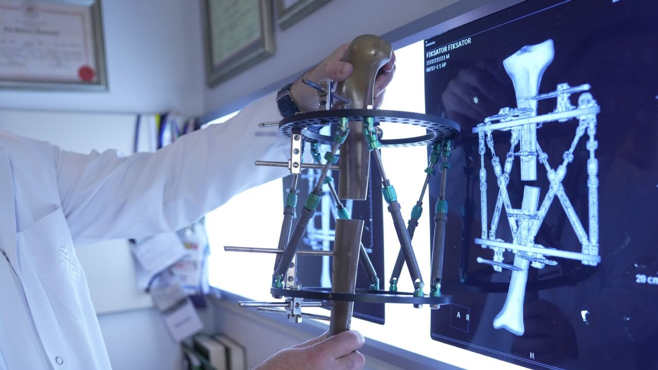 Boy kısalığına çözüm: Kemikler uzatılabilir