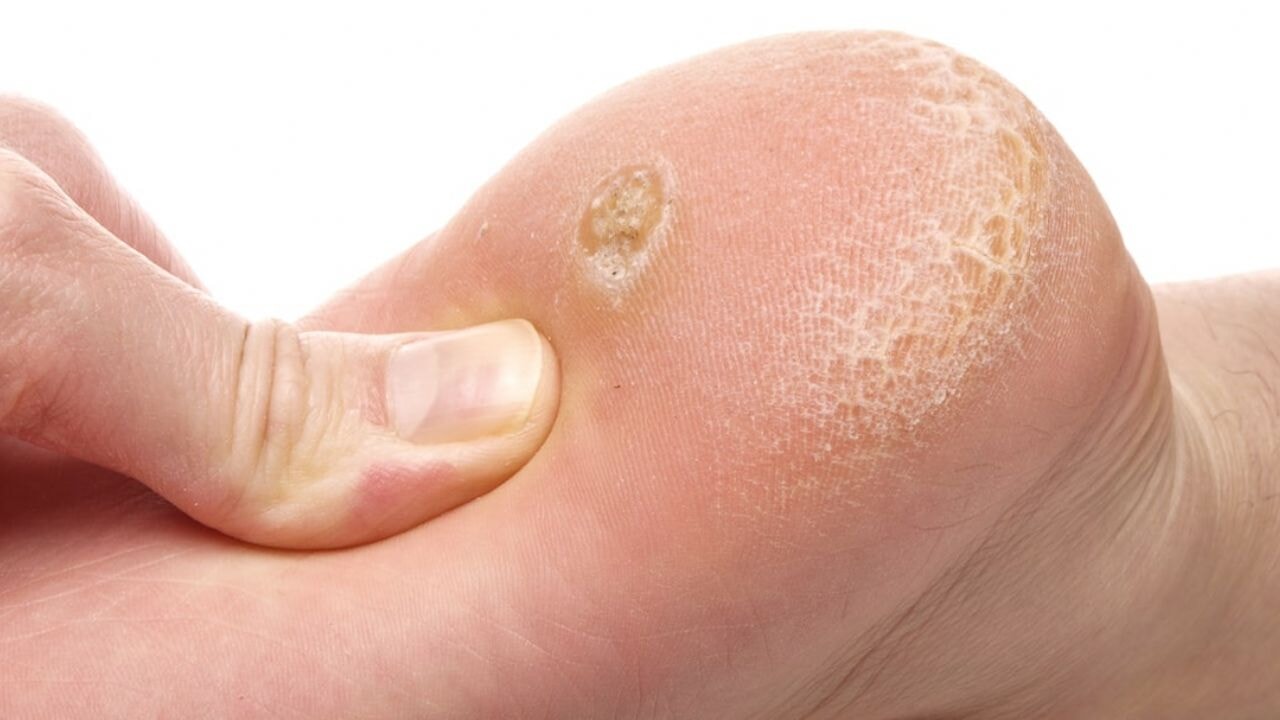 Mantarın kökünü kurutuyor! Nasır, egzama ve mantara 5 dakikada çözüm