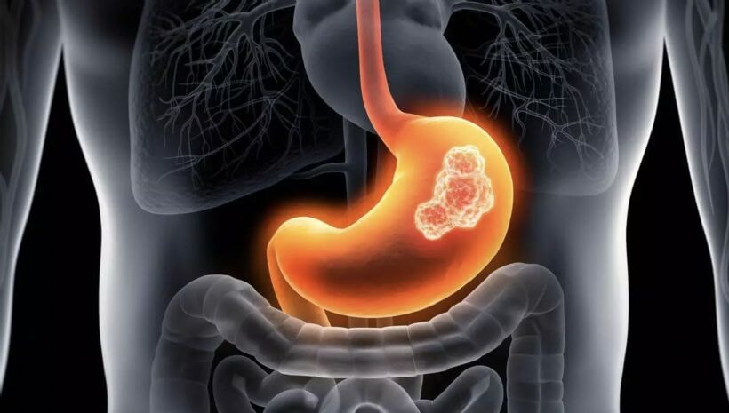 Mide yanması neden olur ve en etkili tedavi yöntemleri nelerdir? Gece uyutmayan mide yanmasının 5 nedeni