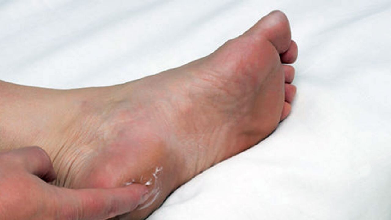 Uzmanlardan topuk dikeni uyarısı: 'Çözüm dikeni kırmak değil'