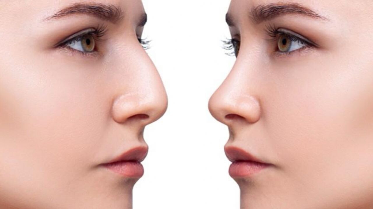 Burun Estetiği ve Burun Dolgusu: Farkları, Avantajları ve Süreçleri