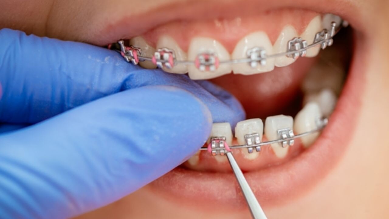 Diş Teli Fiyatları Hakkında Merak Edilenler ve Güncel Bilgiler