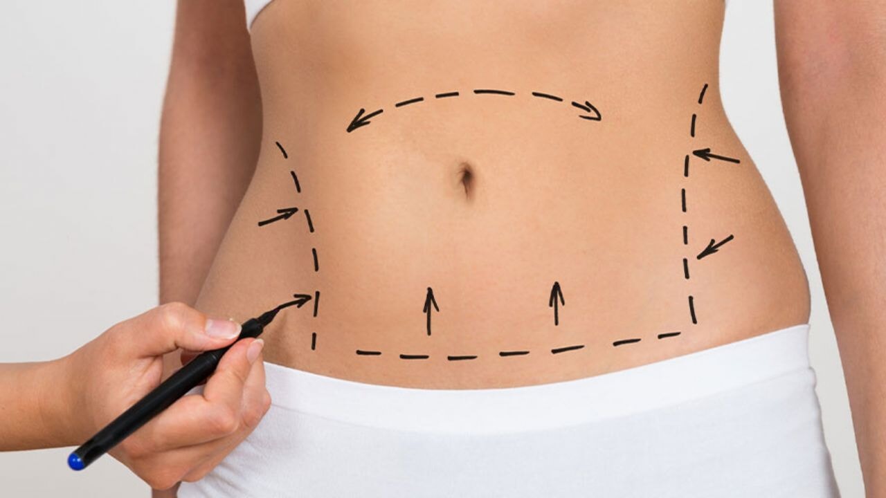 Karın Germe Ameliyatı: Estetik ve Fonksiyonel Yenilenme